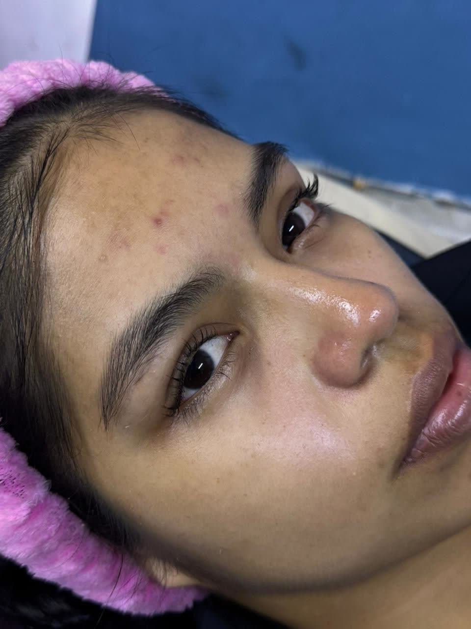 Piel después de una limpieza facial