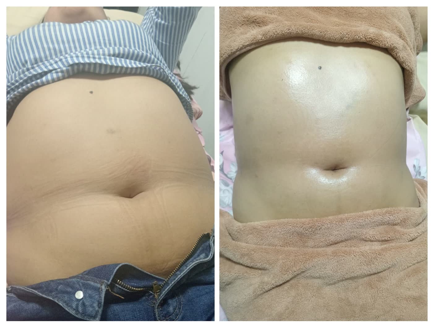 Antes y después de masaje reductor